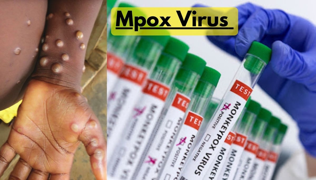 Mpox Virus